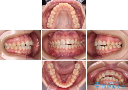 気になる残存乳歯と八重歯 ワイヤー矯正を併用したインビザライン治療の治療中