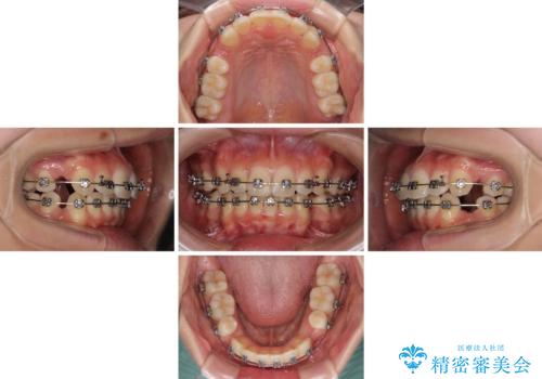 短期間で口元の突出感を改善　ワイヤー装置での抜歯矯正の治療中