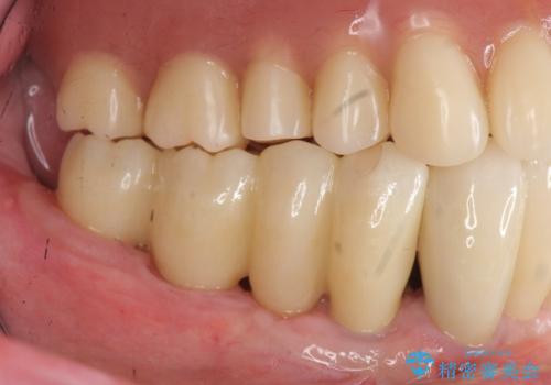 [ インプラントオーバーデンチャー ] インプラント+入れ歯・ブリッジで作るしっかりとした咬合状態の治療後