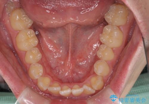 非抜歯ワイヤー装置による、短期間での矯正治療の治療前