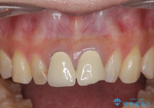 [ 前歯部セラミック治療 ]目立つ前歯をきれいにしたいの治療前