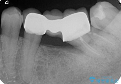 歯周病治療の症例 治療前