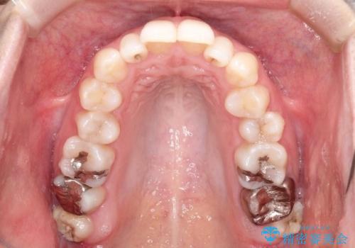 【前歯のがたつきでお悩みの方必見】インビザライン矯正の症例の治療前