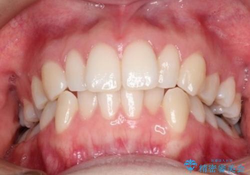 【前歯のがたつきでお悩みの方必見】インビザライン矯正の症例の治療前