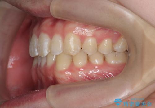 クロスバイト・歯並びが原因の歯肉退縮歯、矯正治療による審美性の改善の治療後