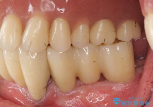 [ インプラントオーバーデンチャー ] インプラント+入れ歯・ブリッジで作るしっかりとした咬合状態の治療後