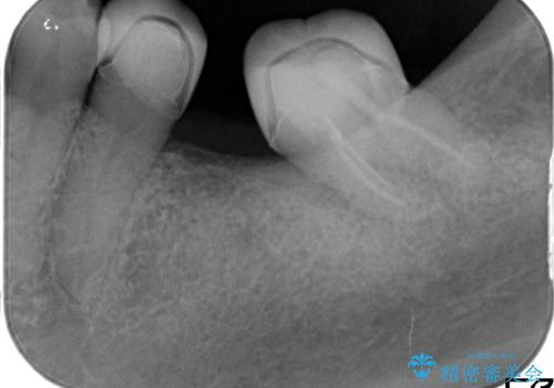 部分矯正してからオールセラミックブリッジの治療前
