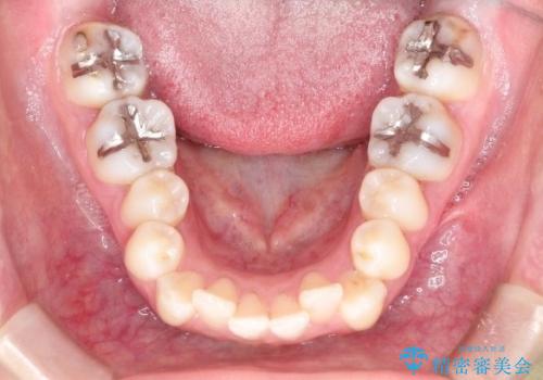 【前歯のがたつきでお悩みの方必見】インビザライン矯正の症例の治療前