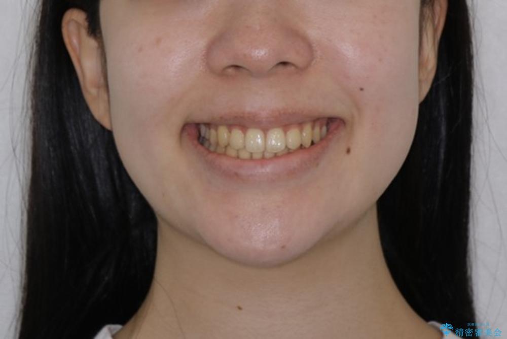 八重歯の解消とインプラントの下準備をインビザラインでの治療後（顔貌）