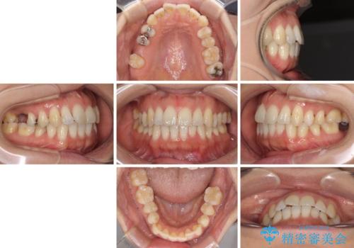 後戻りの再矯正治療と欠損部の補綴治療の治療前