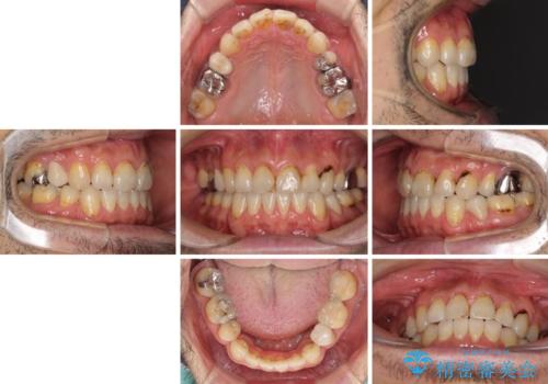 むし歯や銀歯が気になる　後戻りの再矯正治療とむし歯治療の治療前