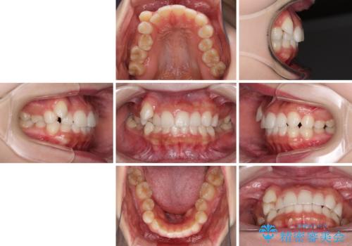 八重歯を改善 目立たないワイヤー装置での矯正治療の治療前
