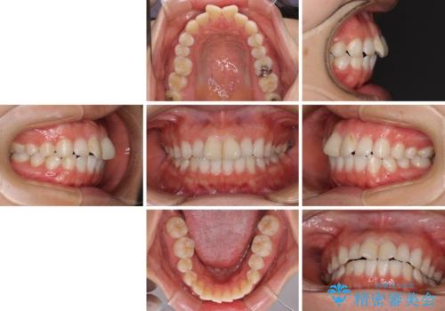 前歯の捻れを改善 インビザラインによる矯正治療の治療前