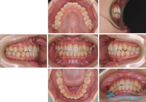 むし歯になりやすい奥歯 補助装置で一気に解決の治療前