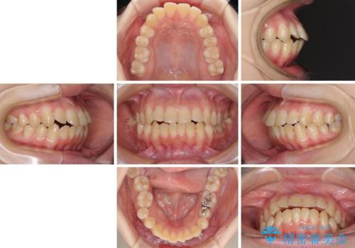上下の出っ歯を治したい ワイヤー装置による抜歯矯正の治療前