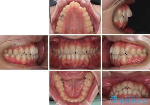 非抜歯ワイヤー装置による、短期間での矯正治療の治療前