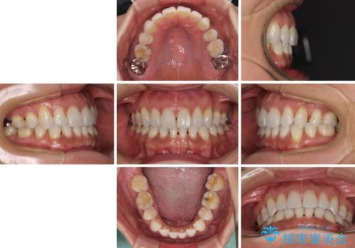 抜歯矯正の後戻りをインビザライン・ライトで解消の治療前