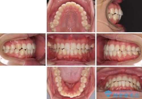 インビザラインで奥歯の咬み合わせと前歯のデコボコを改善の治療前