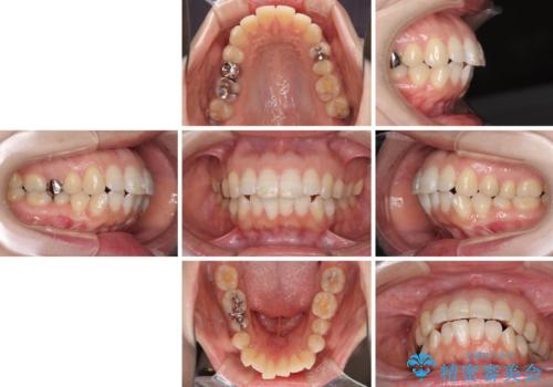 口元の突出感改善 なるべく銀歯を抜歯してワイヤー矯正の治療前