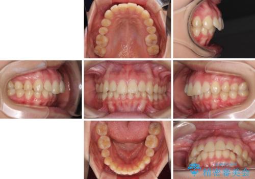 上顎前突 目立たないワイヤー装置での抜歯矯正の治療前