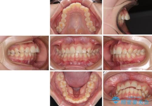 カリエール・ディスタライザーとインビザラインを用いた奥歯の咬み合わせ改善の治療前