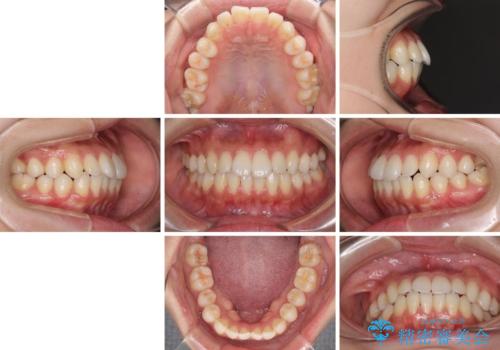 インビザラインで口を閉じやすくの治療前