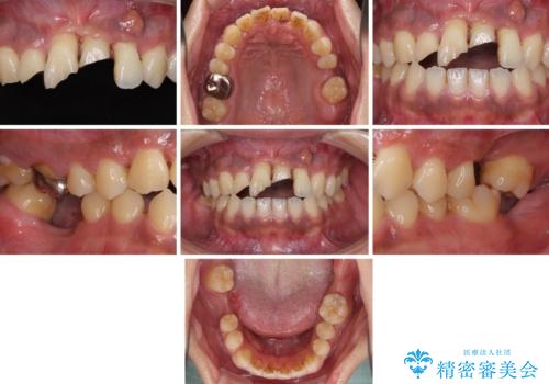 事故で抜歯となった前歯 ブリッジやインプラントによる補綴治療の治療前