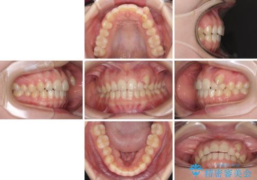 気になる残存乳歯と八重歯 ワイヤー矯正を併用したインビザライン治療の治療前