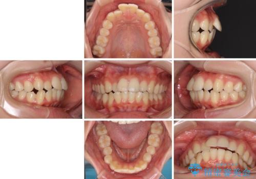 短期間で口元の突出感を改善　ワイヤー装置での抜歯矯正の治療前