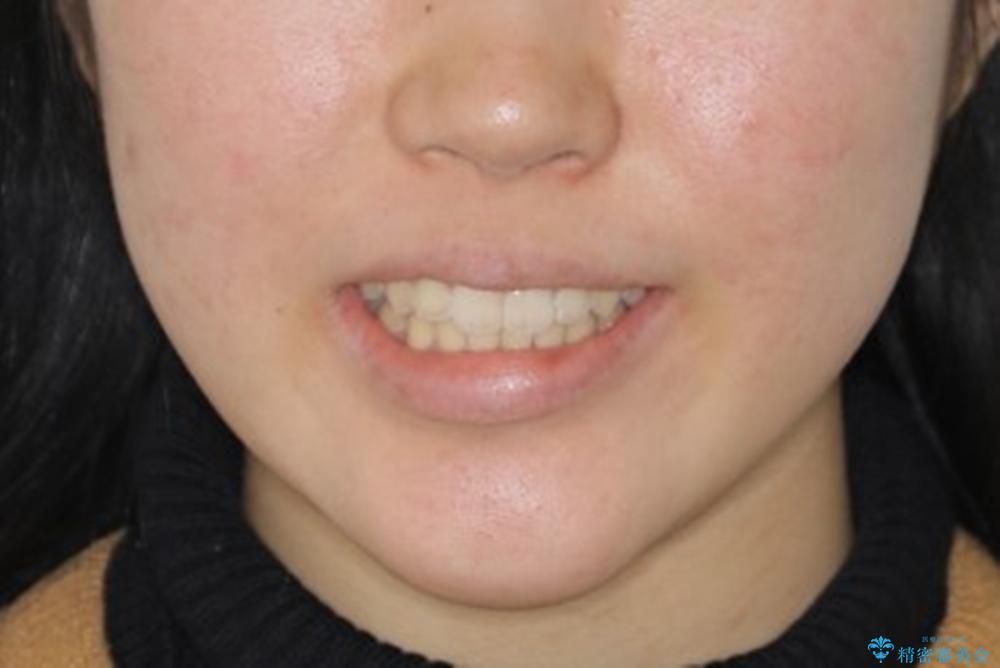 短期間ですきっ歯を改善:インビザラインLiteの治療後（顔貌）