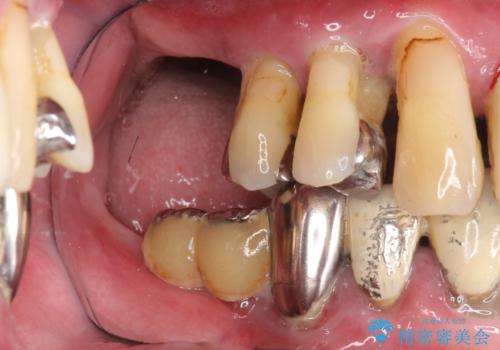 [ インプラントオーバーデンチャー ] インプラント+入れ歯・ブリッジで作るしっかりとした咬合状態の治療前