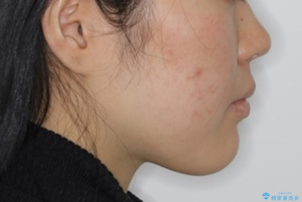 短期間ですきっ歯を改善:インビザラインLiteの治療後(顔貌)