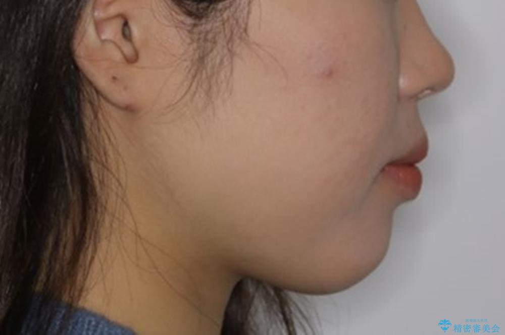 短期間ですきっ歯を改善:インビザラインLiteの治療前(顔貌)