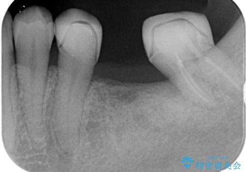部分矯正してからオールセラミックブリッジの治療後