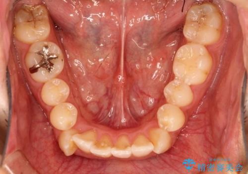 【八重歯・がたつきでお悩みの方必見】抜歯矯正症例(審美ワイヤー矯正)の治療前