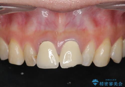 [ 前歯部セラミック治療 ]目立つ前歯をきれいにしたいの症例 治療前