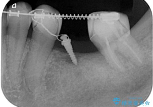 部分矯正してからオールセラミックブリッジの治療中