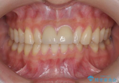 [ 前歯部セラミック治療 ]目立つ前歯をきれいにしたいの治療後
