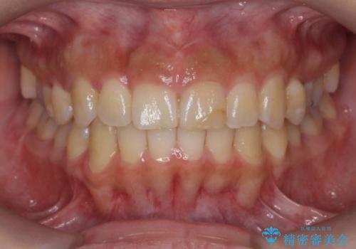 前歯のがたつき　ガミースマイルの改善の症例 治療後