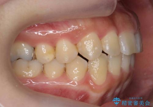 前歯のがたつき ガミースマイルの改善の治療後