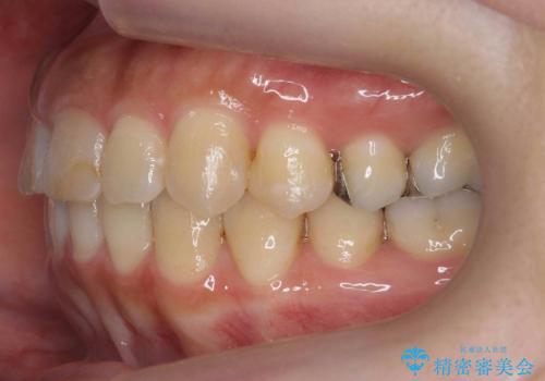 前歯のがたつき　ガミースマイルの改善の治療後