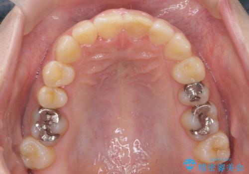 前歯のがたつき ガミースマイルの改善の治療後