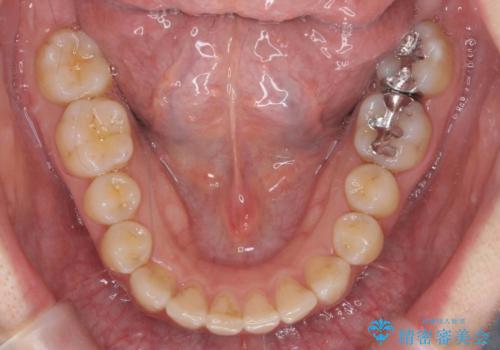 前歯のがたつき ガミースマイルの改善の治療後