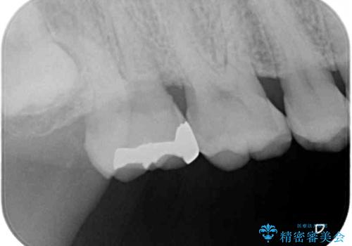 強い咬合力で生じた亀裂からむし歯に　奥歯のゴールドインレー治療の治療前