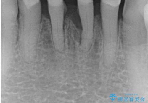 空気が漏れて喋りづらい:適合の良いセラミックで歯をつくるの治療前