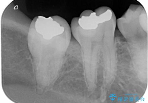 奥歯の深い虫歯の治療後
