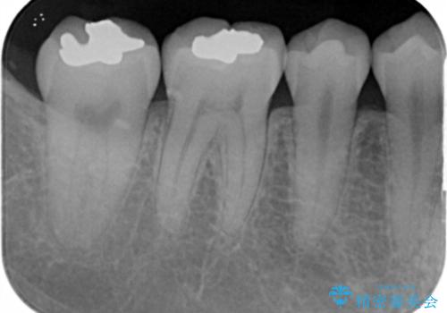 奥歯が黒く、心配。ゴールドインレーで修復の治療後