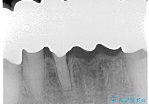 空気が漏れて喋りづらい:適合の良いセラミックで歯をつくるの治療後