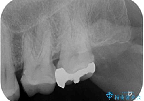 強い咬合力で生じた亀裂からむし歯に 奥歯のゴールドインレー治療の治療前