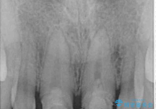 [ 前歯部セラミック治療 ]目立つ前歯をきれいにしたいの治療中
